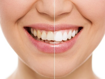 Before and after teeth whitening